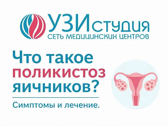  Что такое поликистоз яичников? Симптомы и лечение синдрома